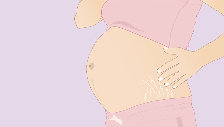 gravid-med-straekmaerker